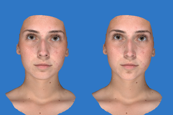 Можно вправить нос. 3д моделирование ринопластика. Операция репозиция костей носа.