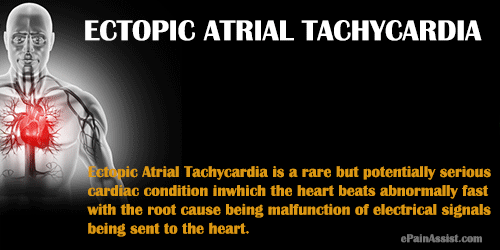 What is ectopic atrial tachycardia GIF - Find on GIFER