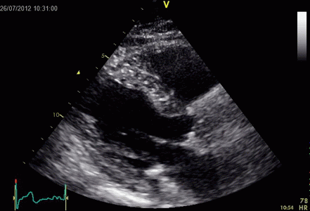 ultrasound,echocardiography,line,doppler