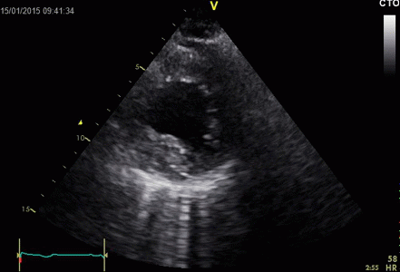 ultrasound,doppler,echocardiography,line