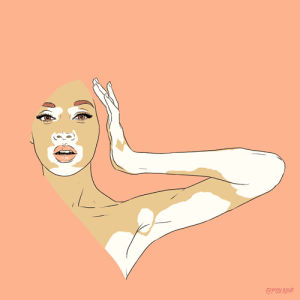 vitiligo models tumblr