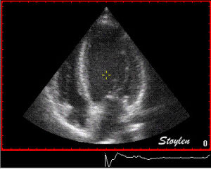 echocardiography,ultrasound,line,doppler
