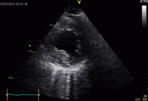 ultrasound,doppler,echocardiography,line